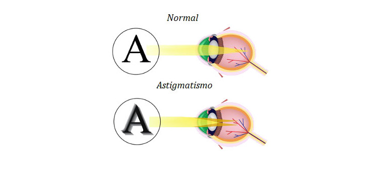 Astigmatismo